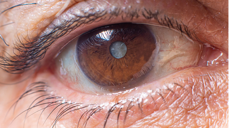 10 perguntas e respostas mais buscadas no Google sobre catarata