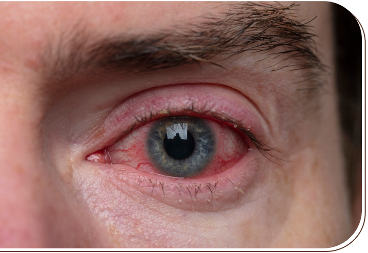 Blefarite, hordéolo e alergias oculares: entenda os termos