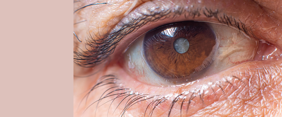 Qualquer pessoa está sujeita à catarata conforme envelhece. Saiba quais são as 10 perguntas mais frequentes sobre a doença no Google.Leia mais...