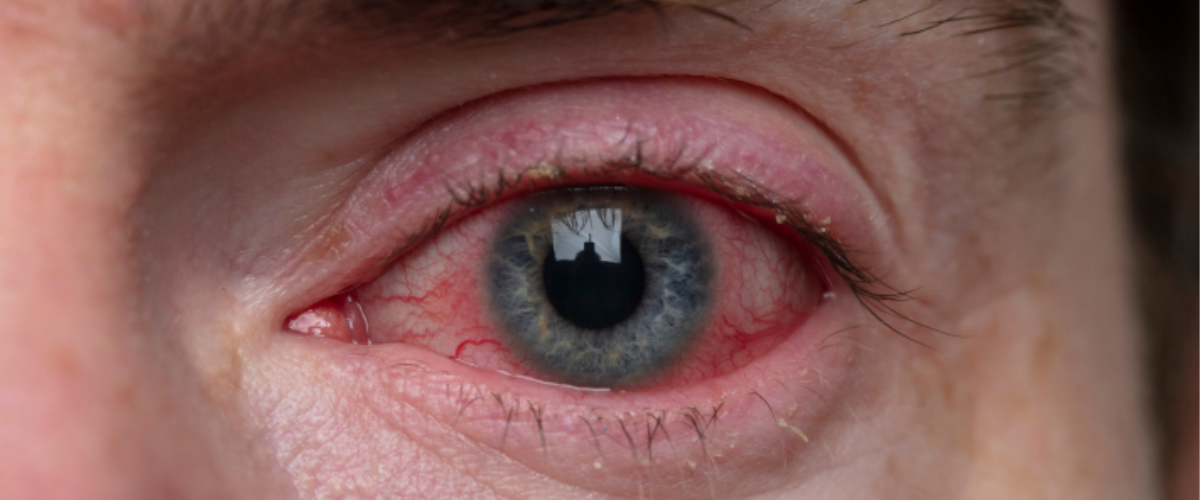 O cuidado com os olhos das crianças é fundamental, especialmente em ambientes escolares, onde a convivência intensa pode favorecer o surgimento de algumas condições oculares. Leia mais...