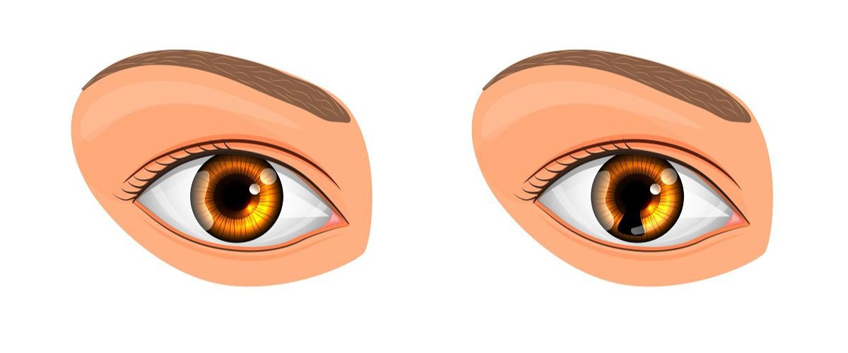 O coloboma pode afetar várias partes do olho, incluindo a íris, a retina, o nervo óptico e as pálpebras.
Leia mais...